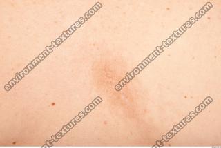 photo texture of scarred skin 0007